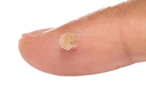 Warts - a skin disease that effectively combats Skincell Pro